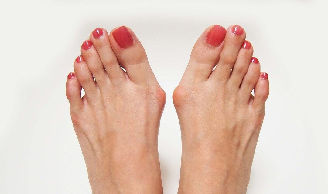Βλαισός Μεγάλος Δάκτυλος ποδιού (Hallux valgus)